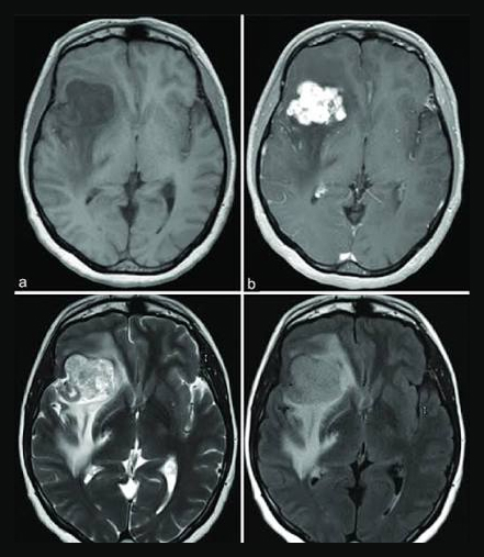 Brain MRI of a tumor imaged with and without a contrast agent
